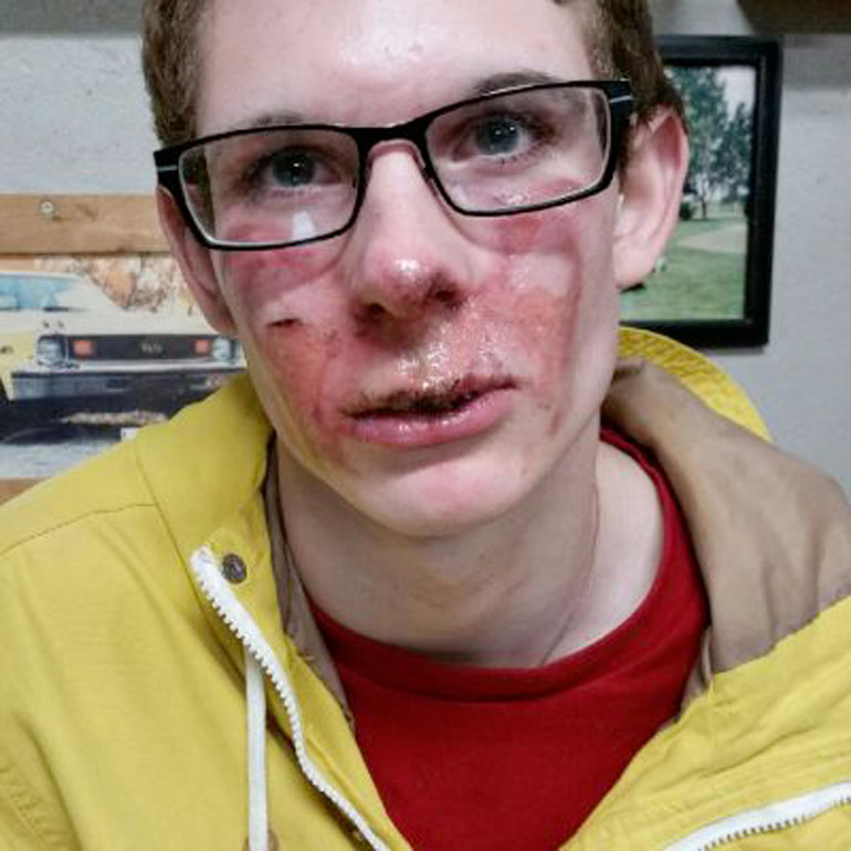 Cigarette electronique explosion