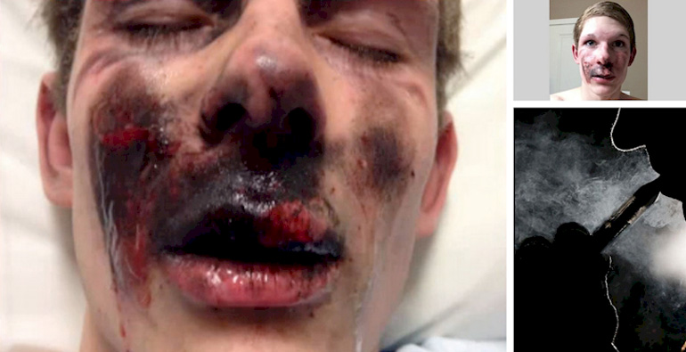 Cigarette electronique explosion