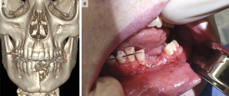 Cigarette electronique explosion